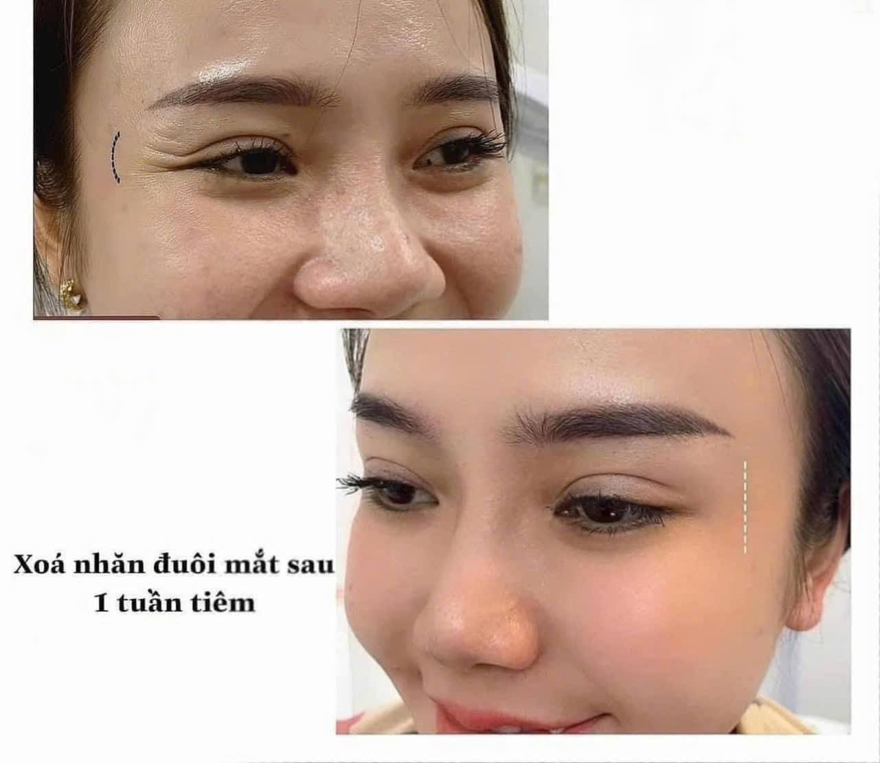 Trước và sau tiêm Botox xóa nhăn đuôi mắt tại Hoa Anh